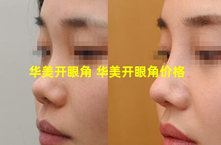 华美开眼角 华美开眼角价格